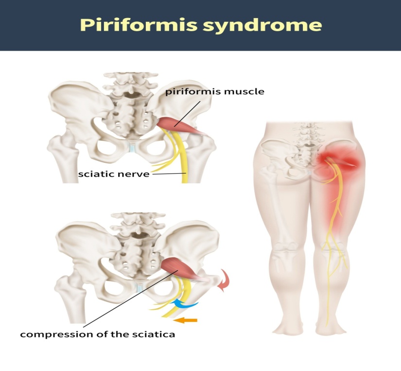 Piriformis Syndrome is caused by compression to the sciatic nerve