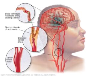Understanding Cerebral Vascular Diseases