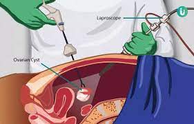 Laparoscopic Hydatid Cystectomy Operated at Govt Gousia Hospital