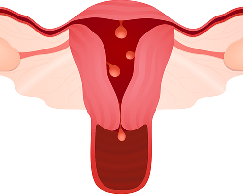 Abnormal Uterine Bleeding (AUB)