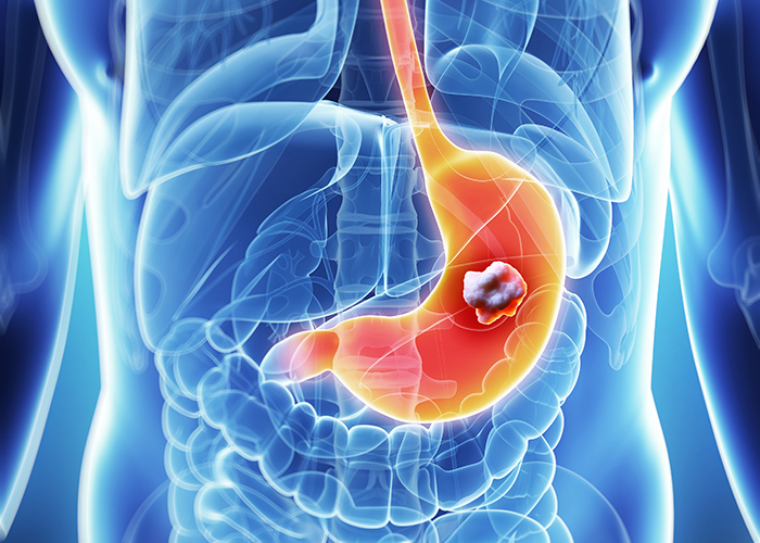 Stomach Cancer: Understanding Its Different Types and Causes