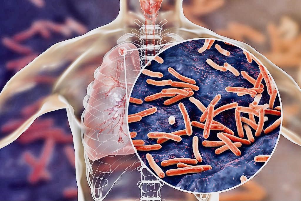 The Global Scourge of Tuberculosis