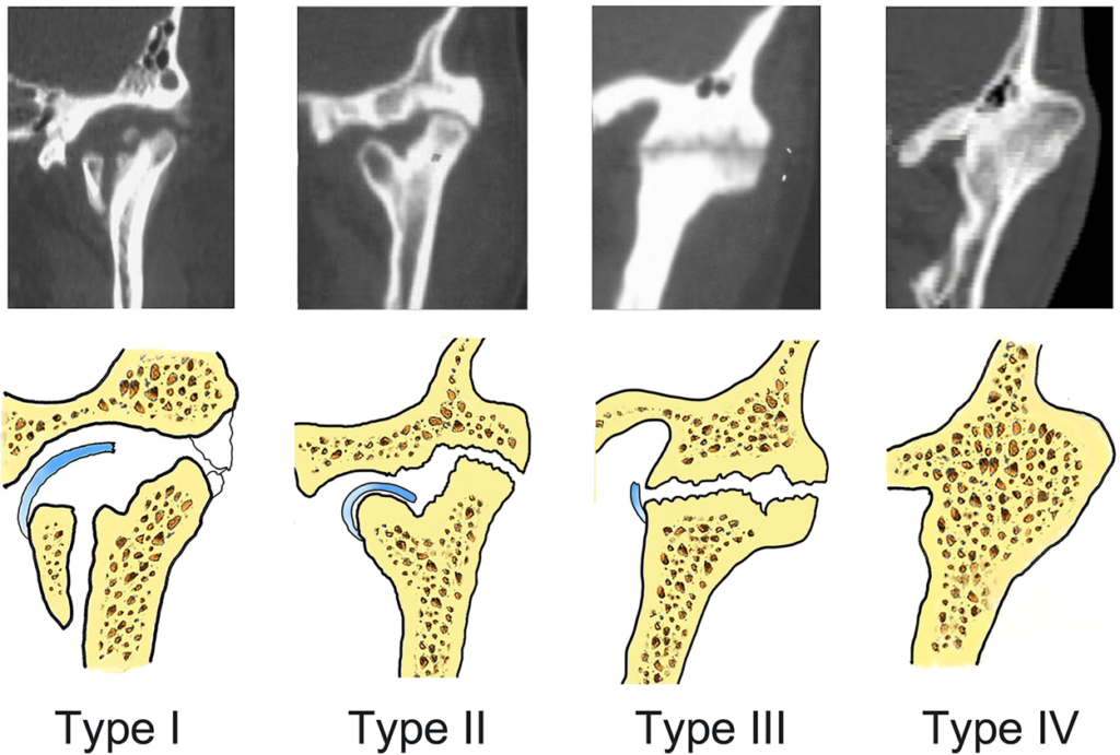 Temporomandibular Joint (TMJ) Ankylosis