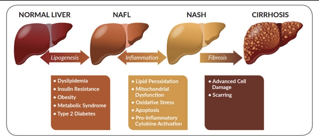 Non-Alcoholic Fatty Liver Disease to NASH