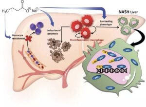 Non-Alcoholic Fatty Liver Disease to NASH