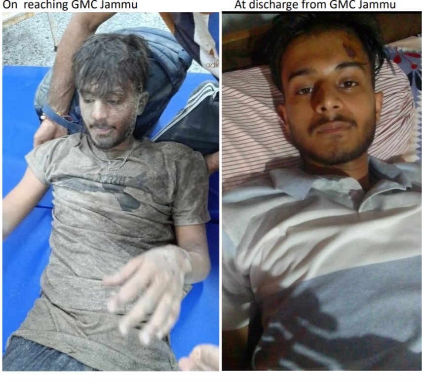 GMC Jammu takes lead in providing World Class treatment to victims of Kishtwar Tragedy